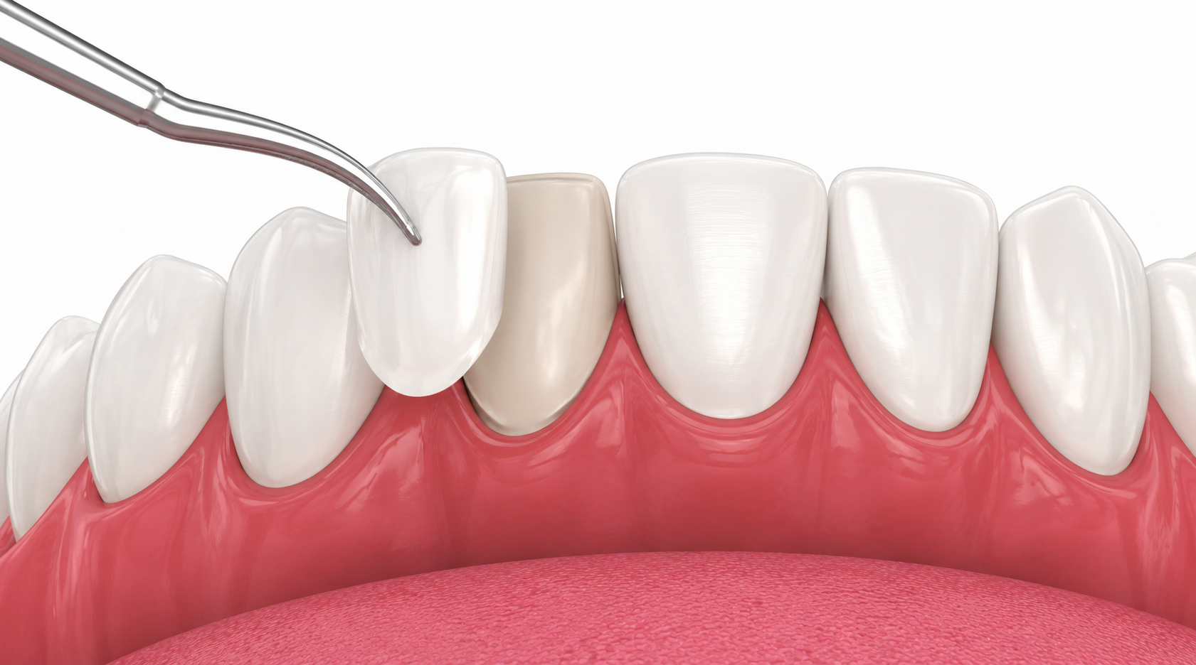 Dental Veneers in Nairobi - Professional dental care and treatment at Express Smiles Dental Suite